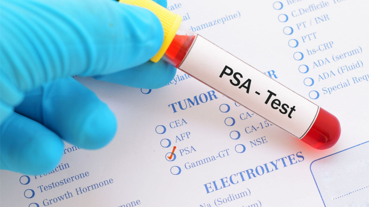 After Prostate Removal What Should PSA Be