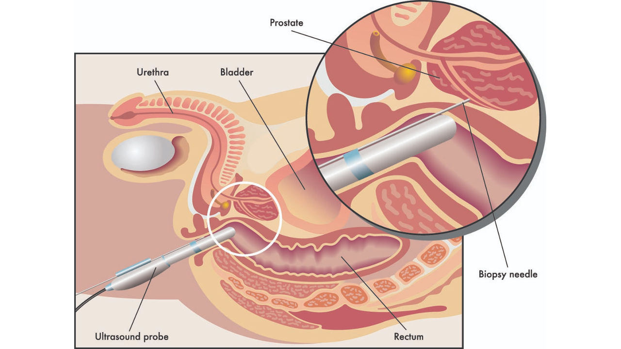 How Long After Prostate Biopsy Can You Ejaculate