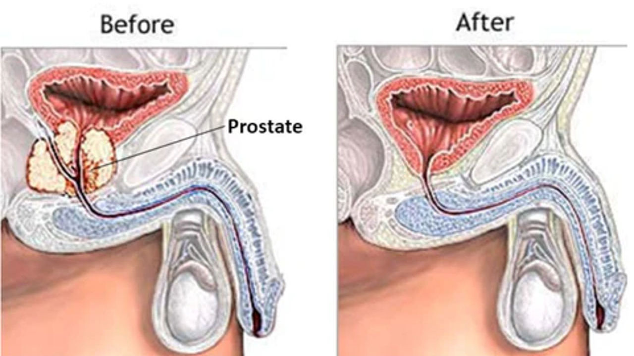 How Long Off Work After Prostate Surgery