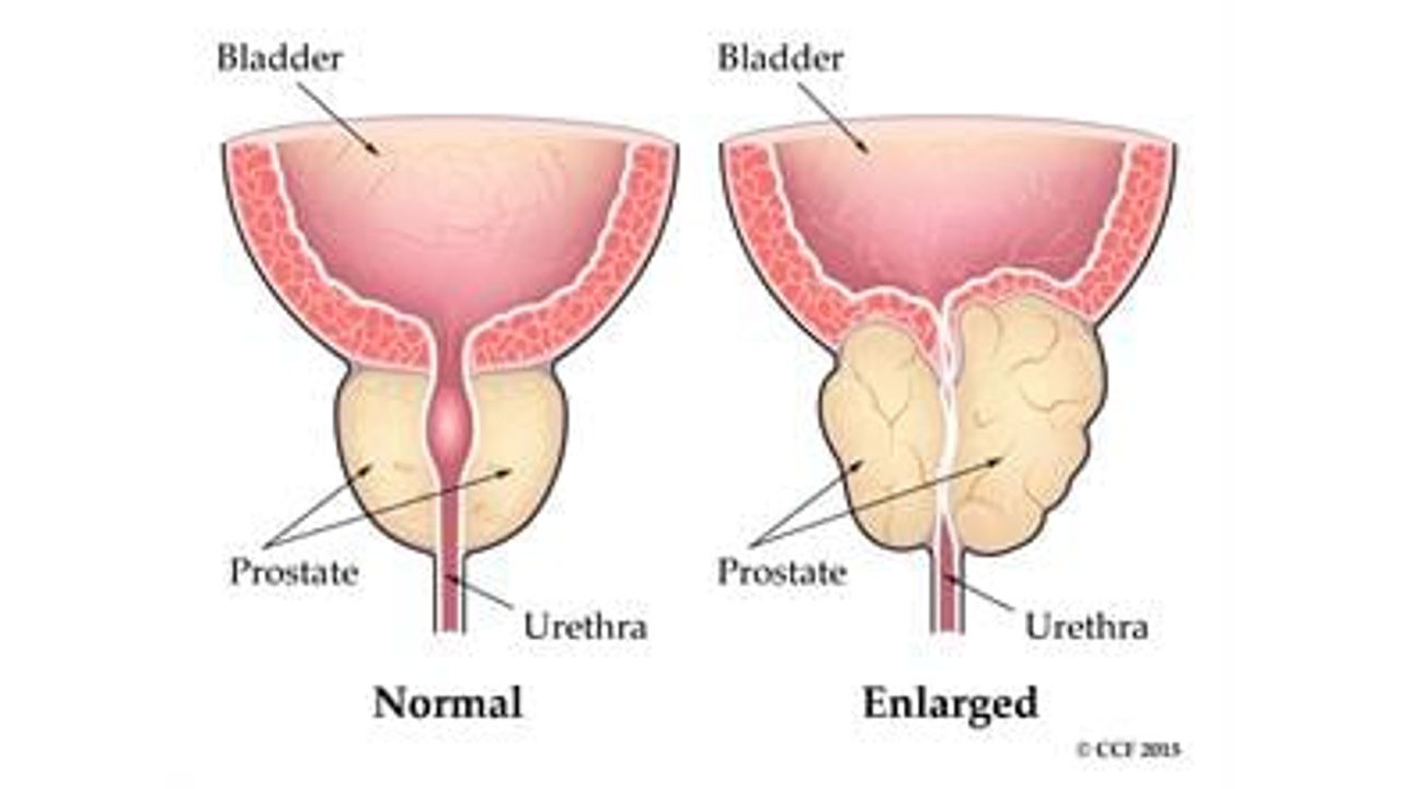 How Much Does It Cost For Prostate Surgery