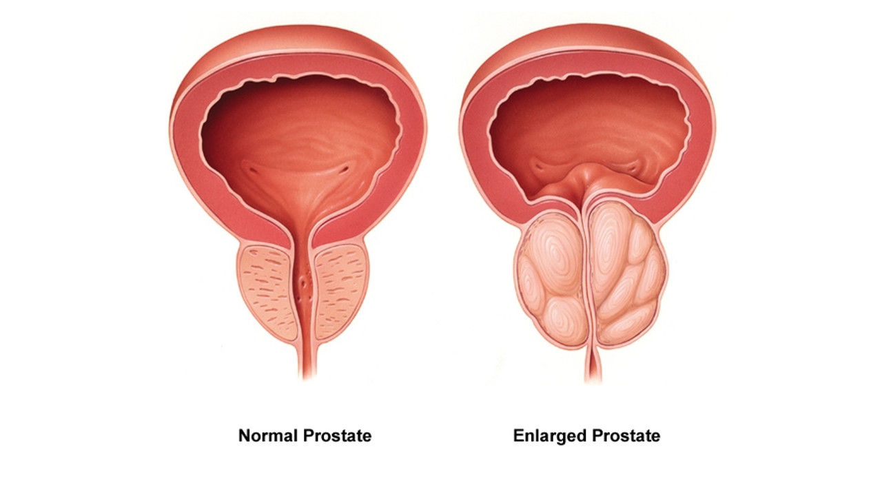 What is a Normal Prostate Size