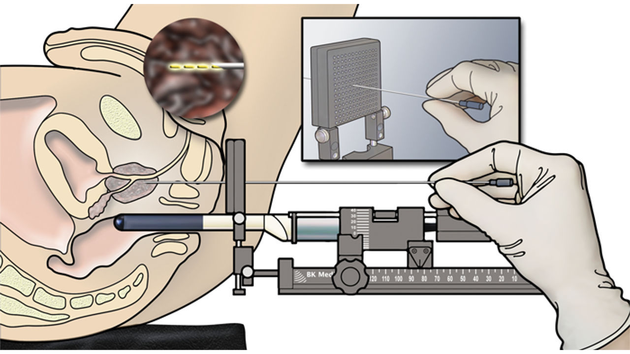 What is a Transperineal Prostate Biopsy