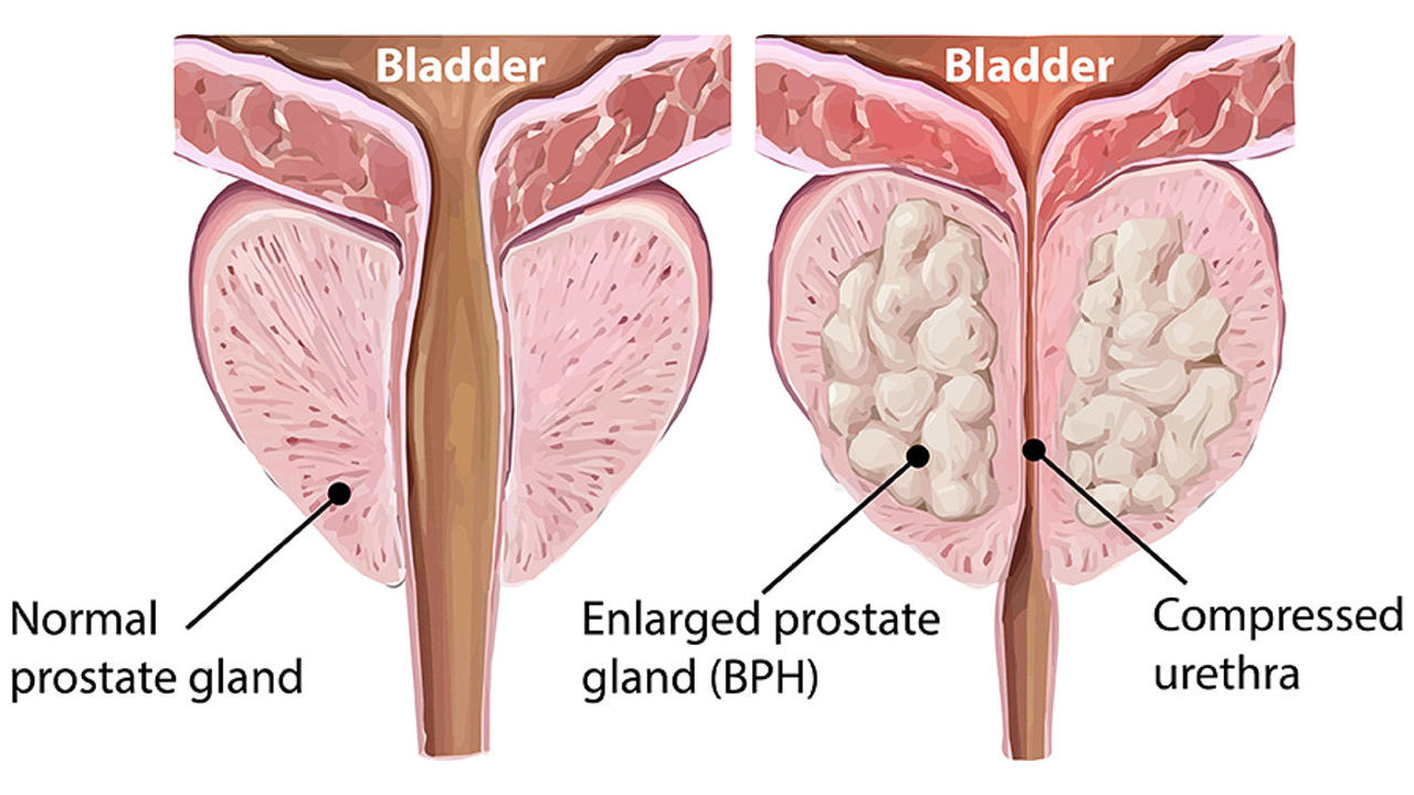 What is the Root Cause of BPH