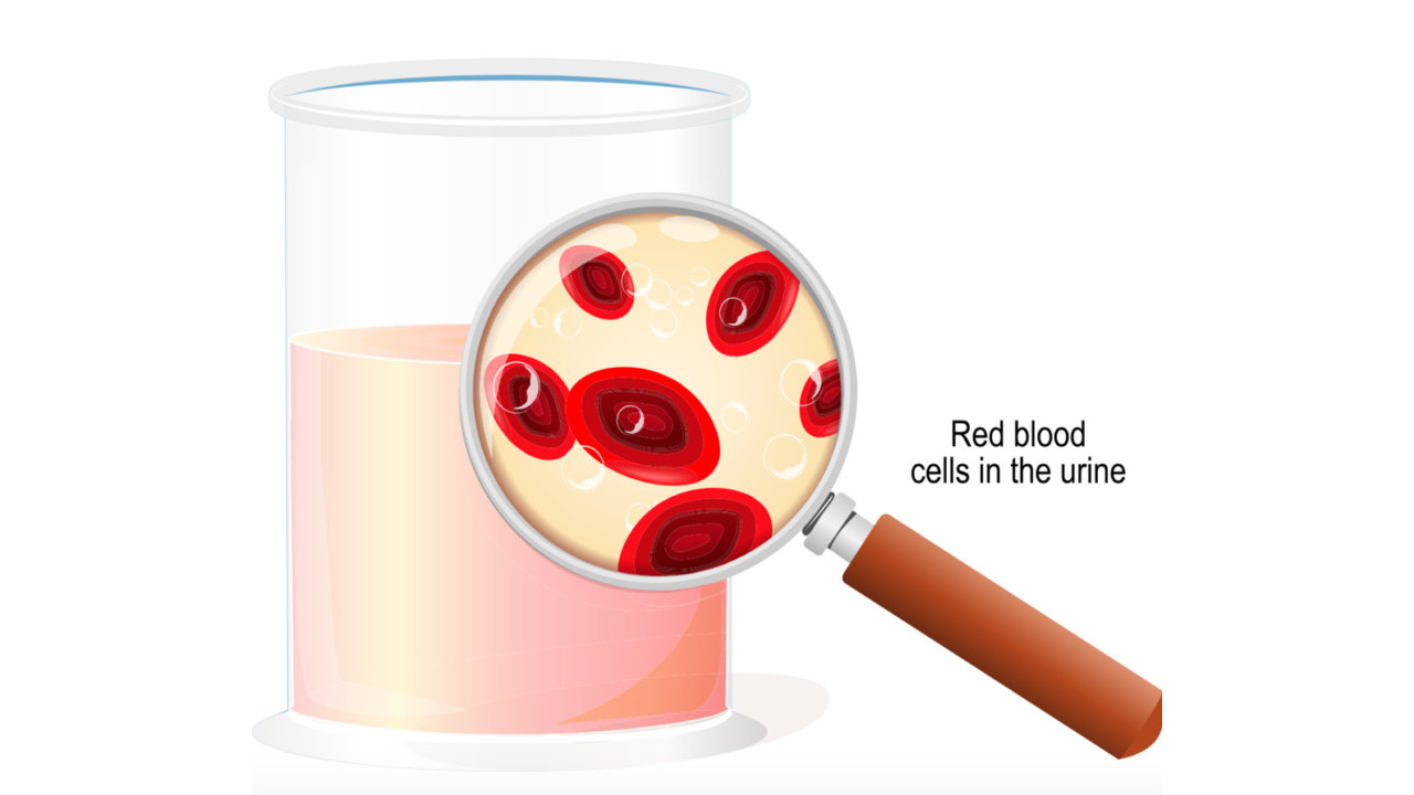 How Does BPH Cause Hematuria