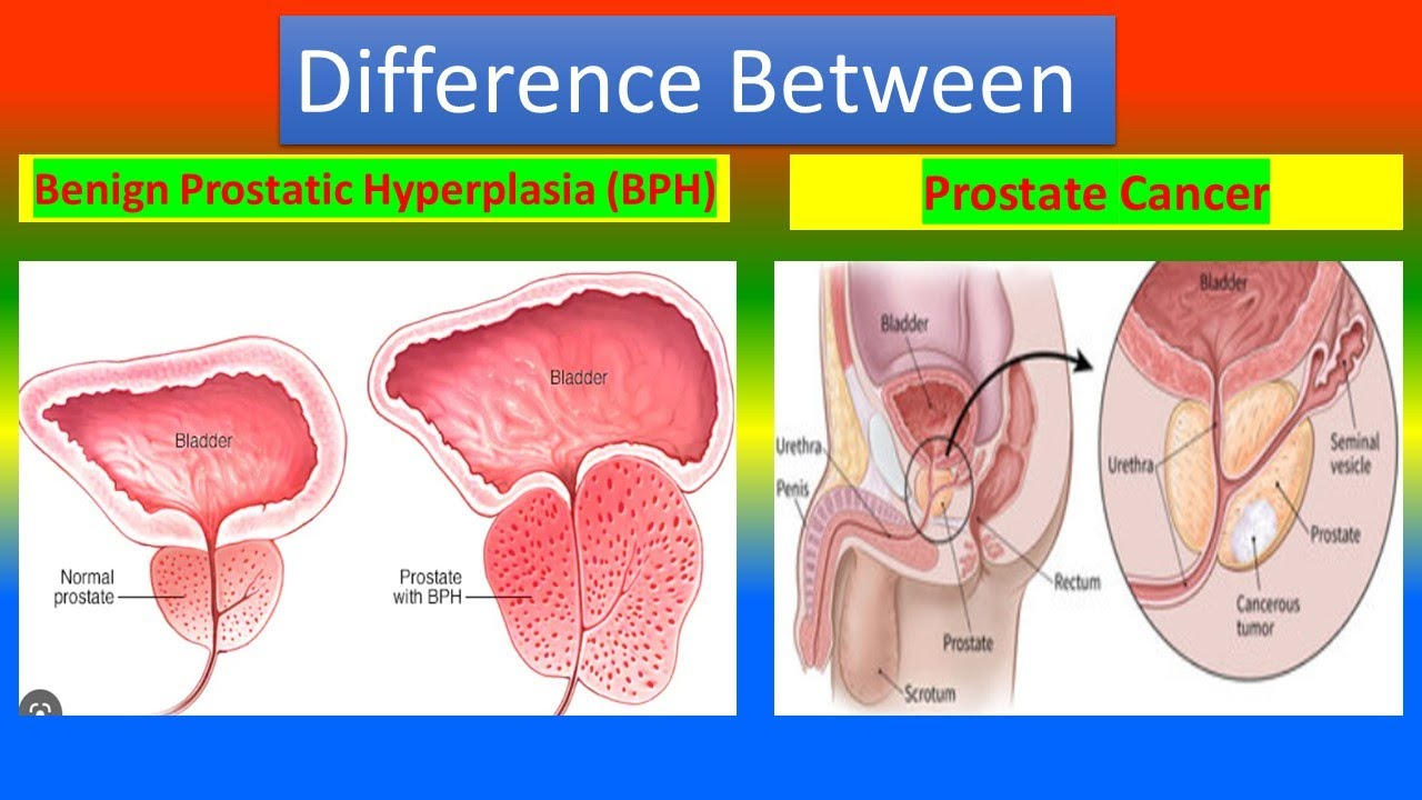 How to Differentiate Prostate Cancer and BPH