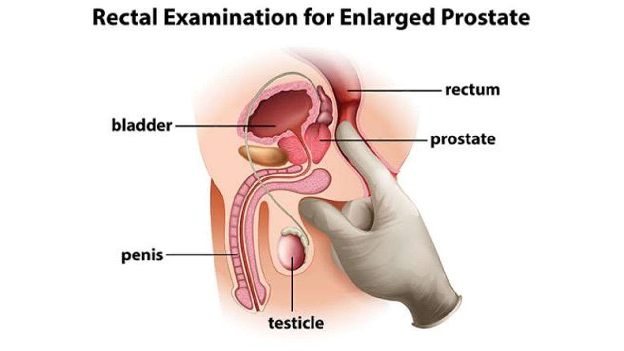 What Does an Enlarged Prostate Feel Like on Exam