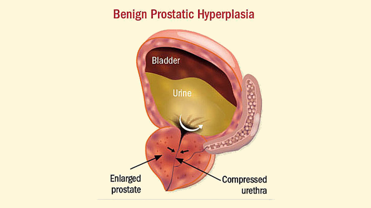 What Size of Prostate is Dangerous