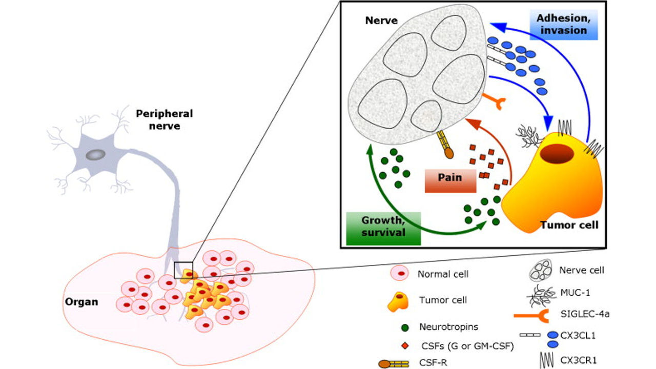 What is Perineural Invasion in Prostate Cancer