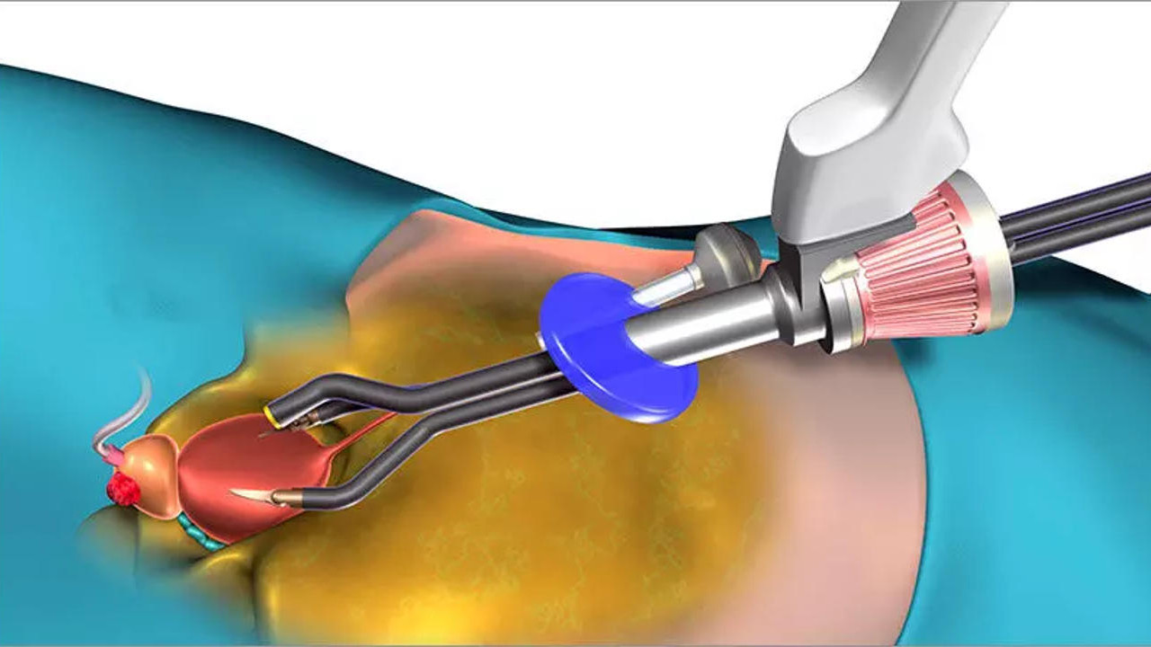 What to Expect After Prostate is Removed