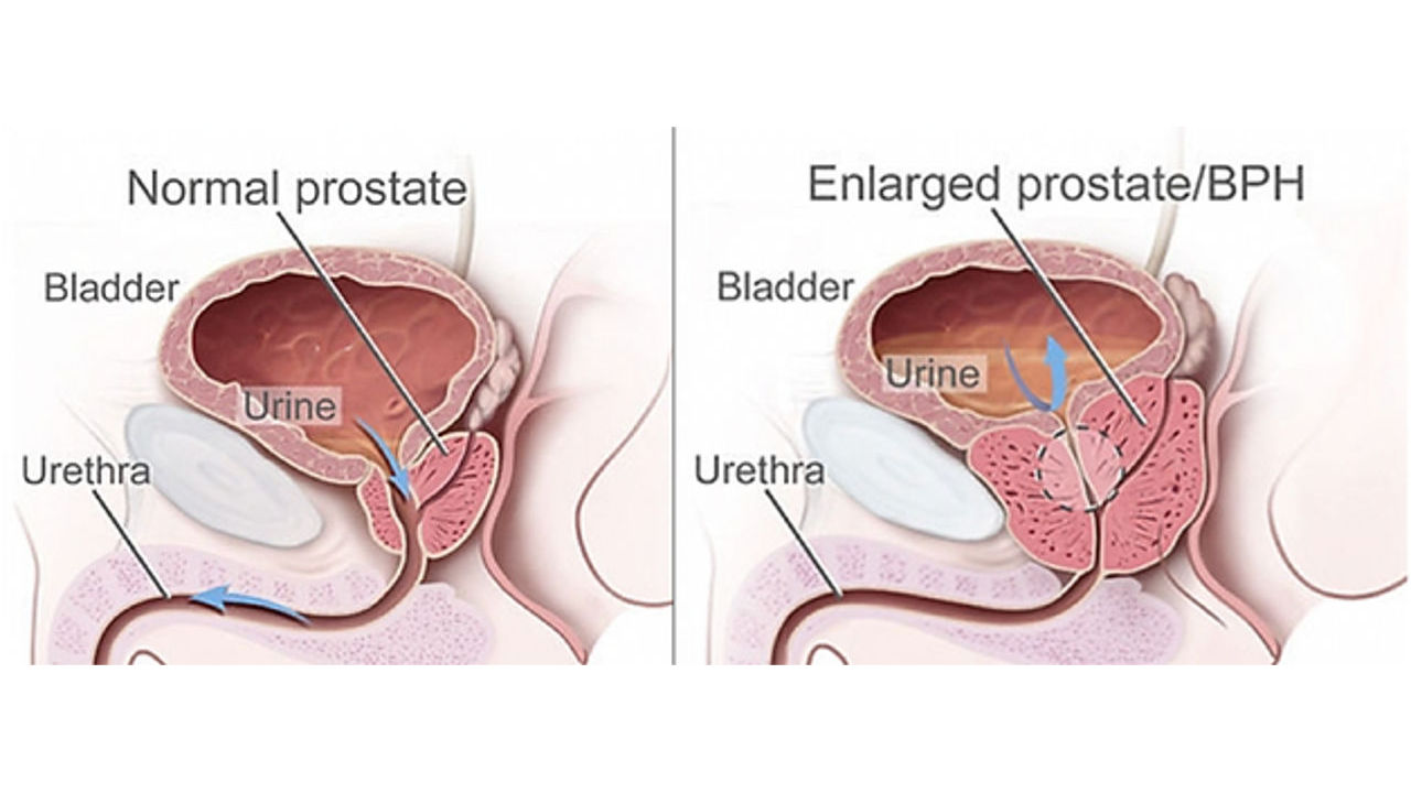 why does enlarged prostate cause frequent urination at night