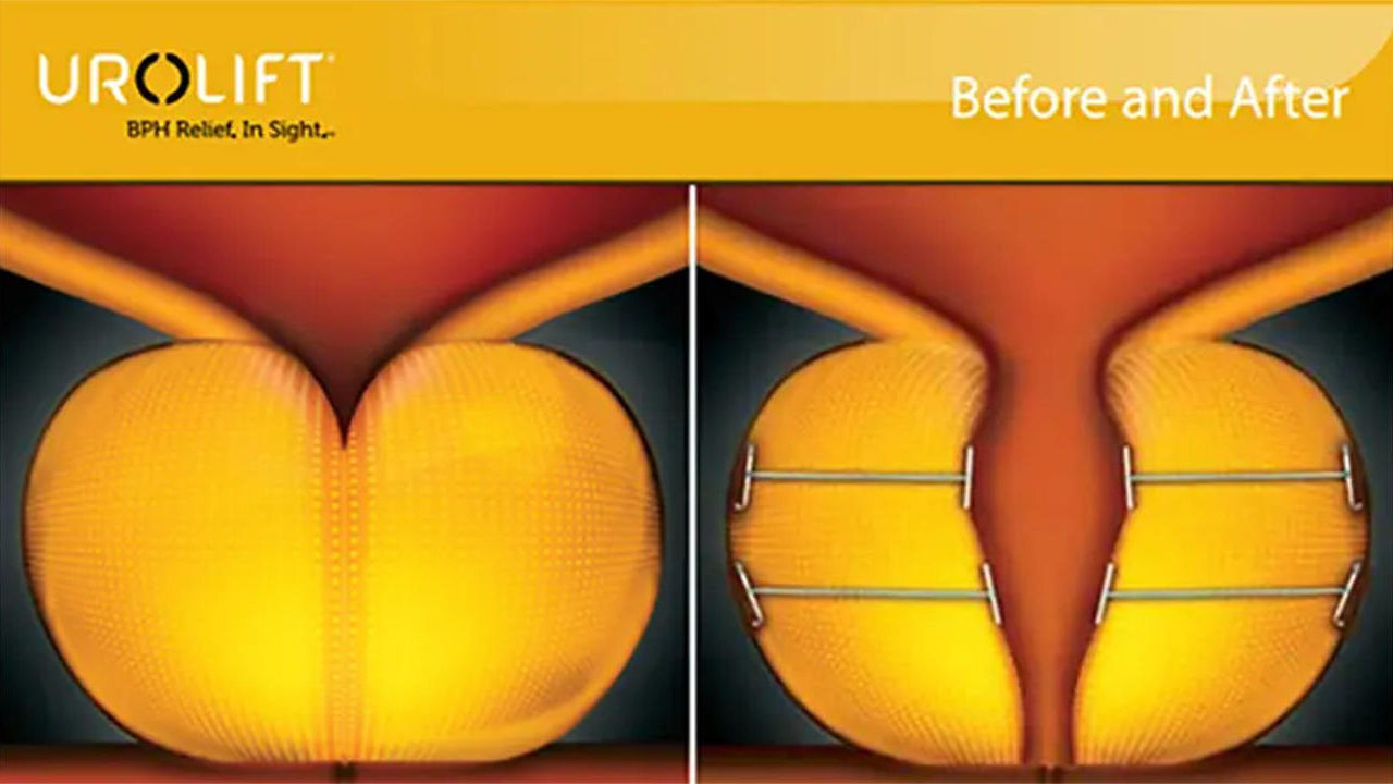 how long does frequent urination last after a UroLift procedure